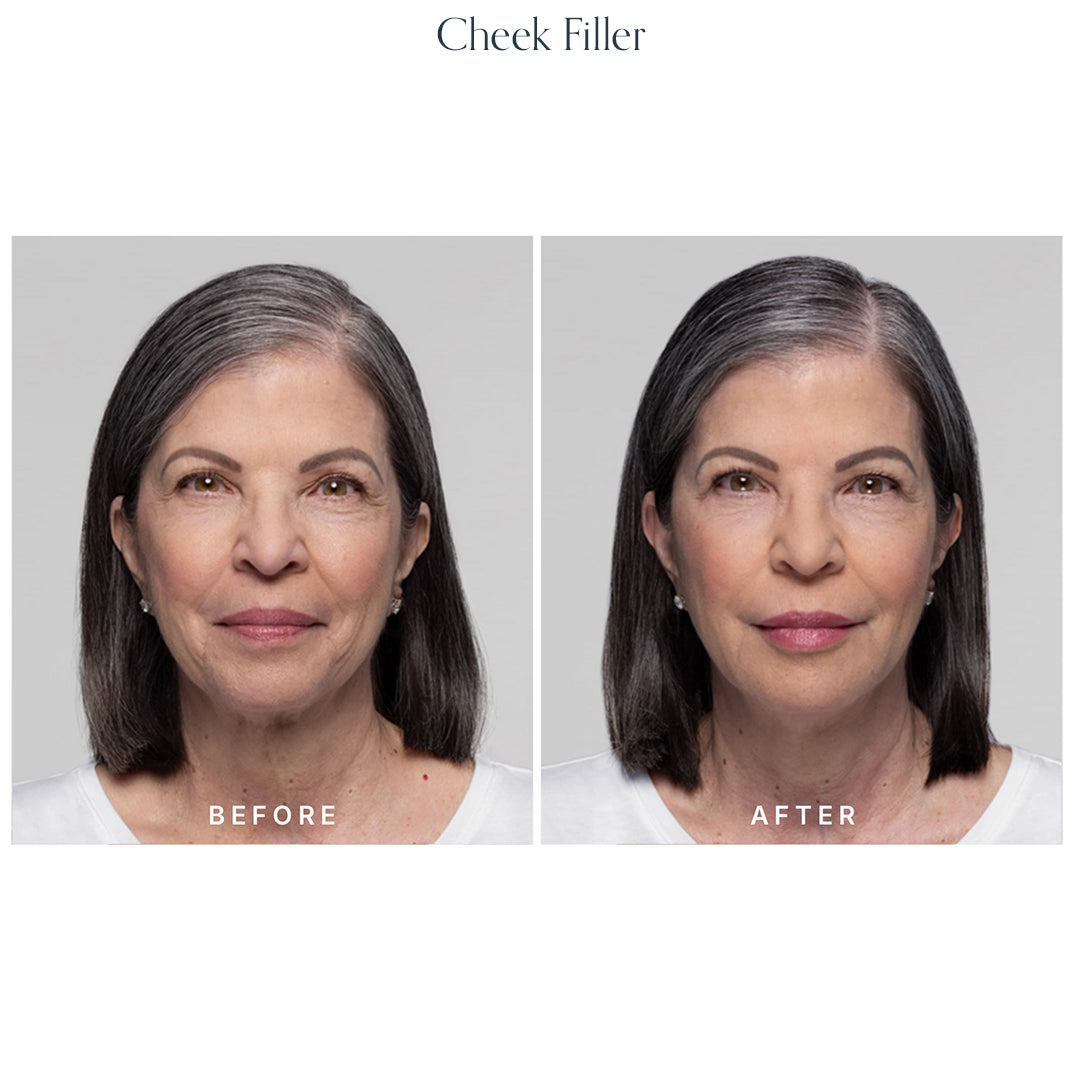 Volume Restore Filler