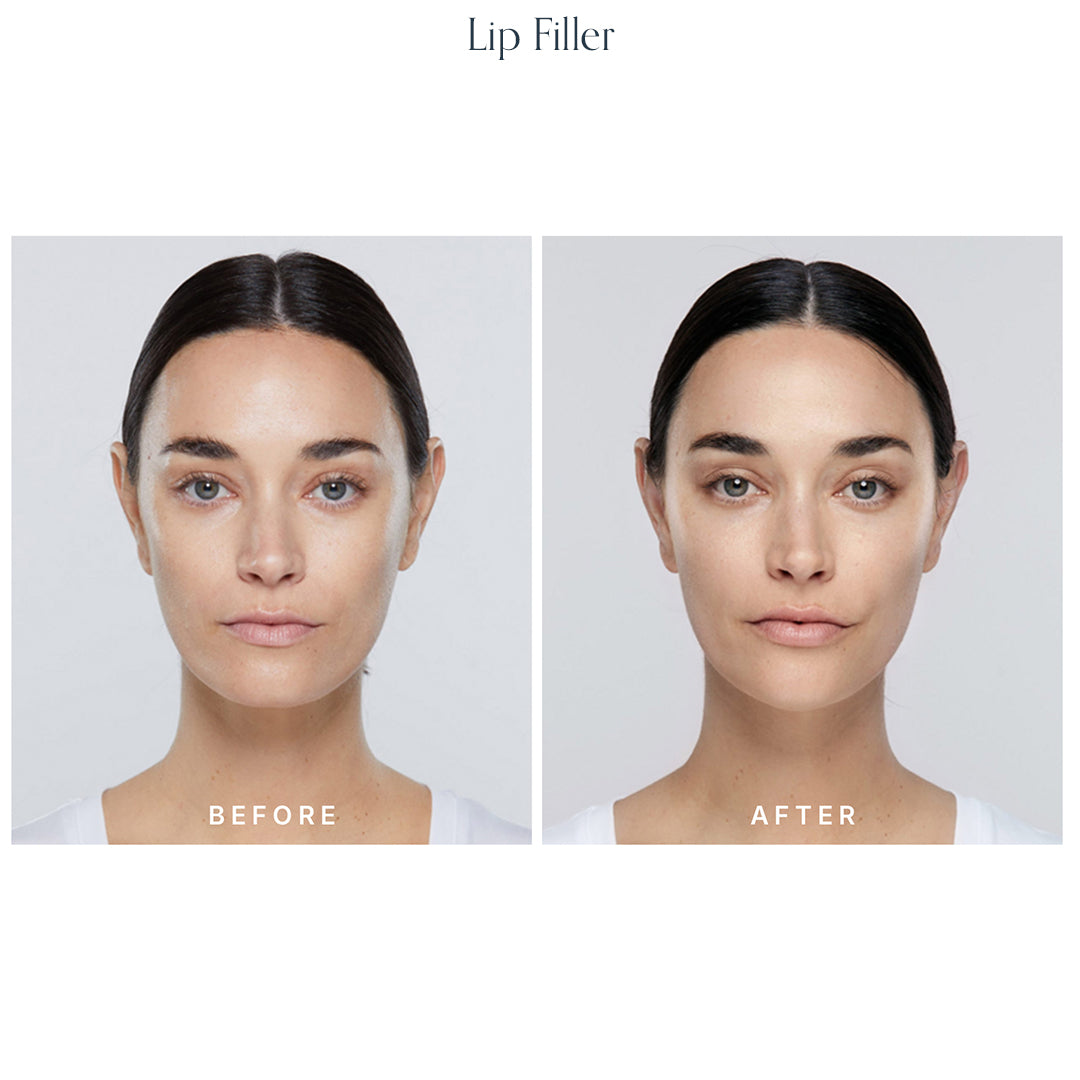 Volume Restore Filler