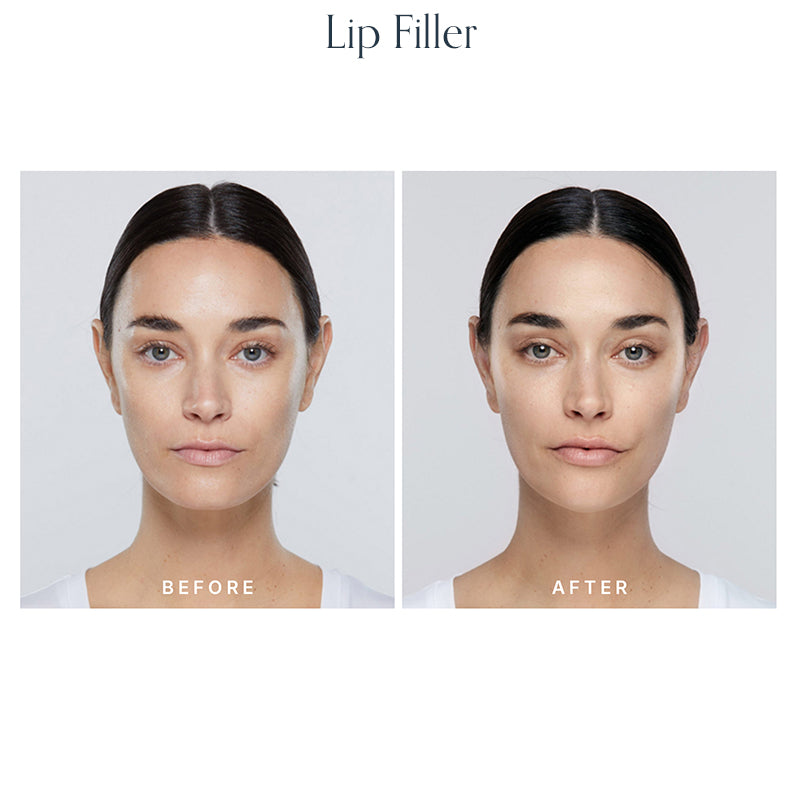 Volume Restore Filler