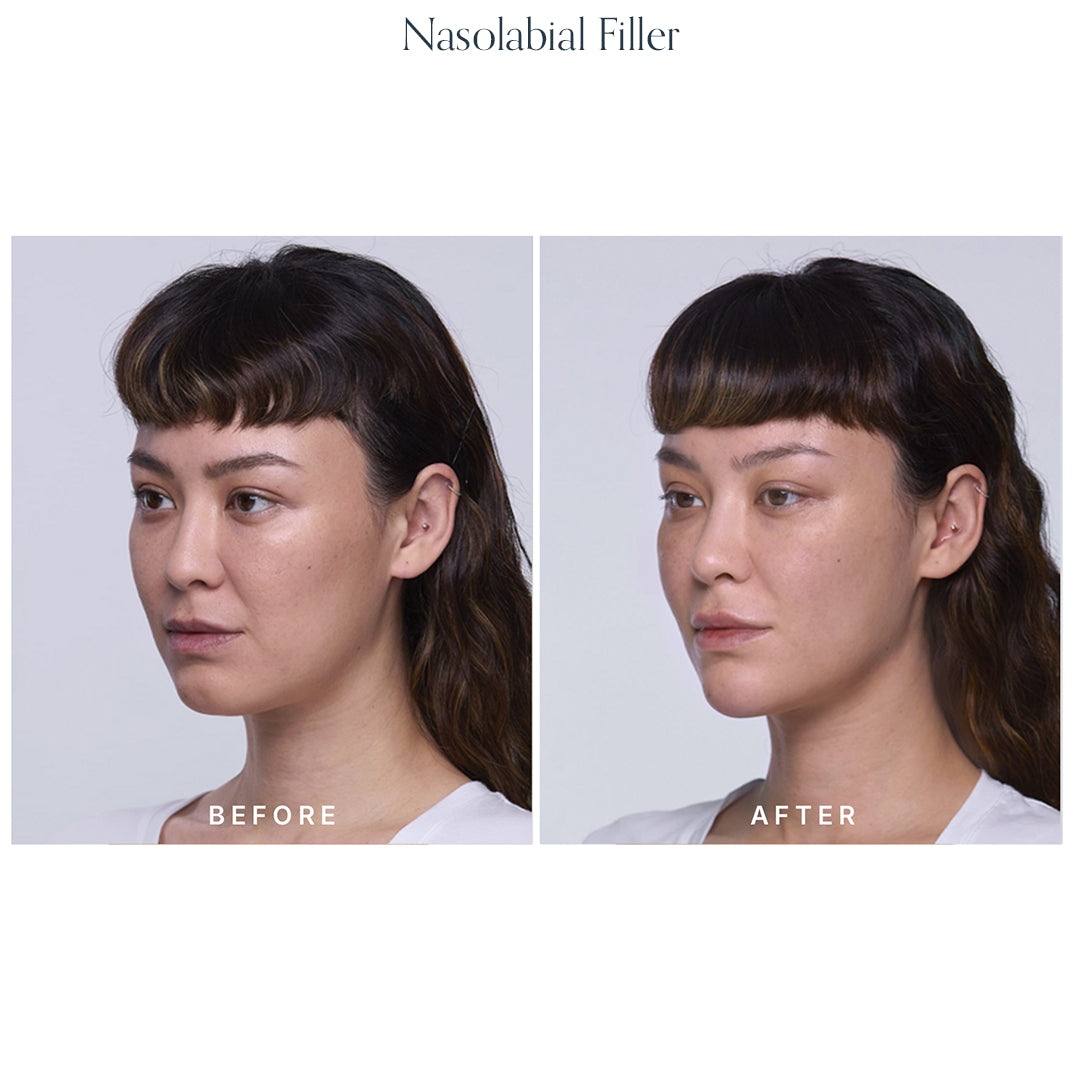 Volume Restore Filler