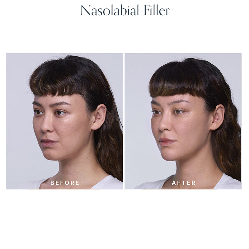 Volume Restore Filler