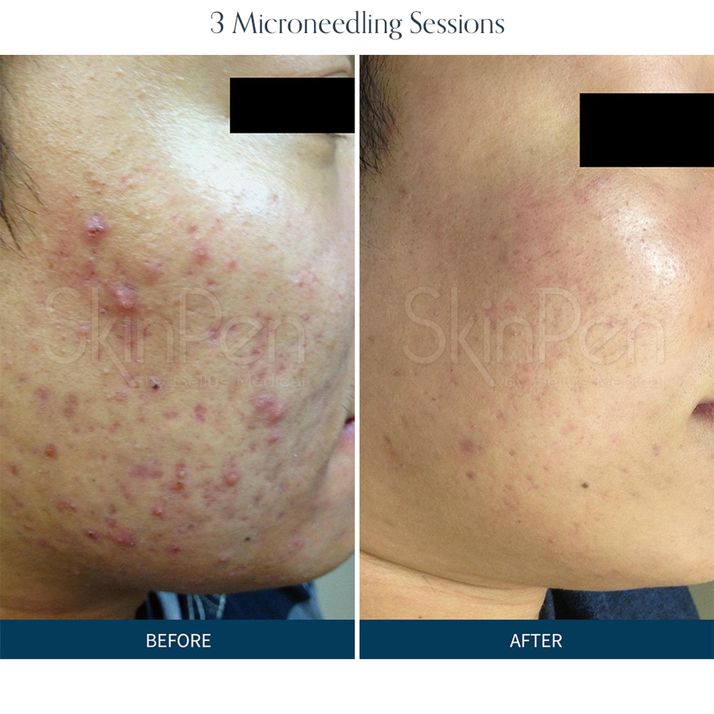 Microneedling