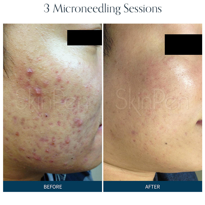 Microneedling