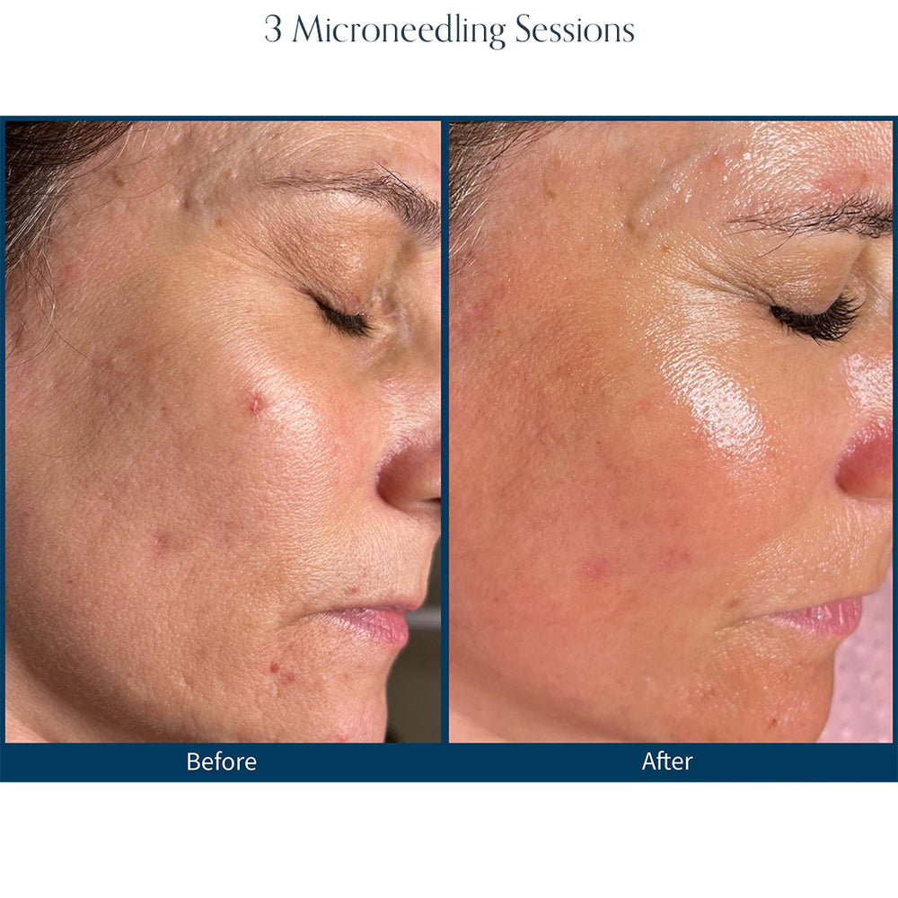 Microneedling