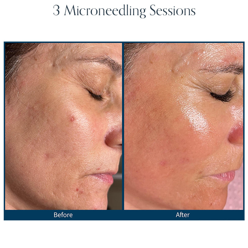 Microneedling
