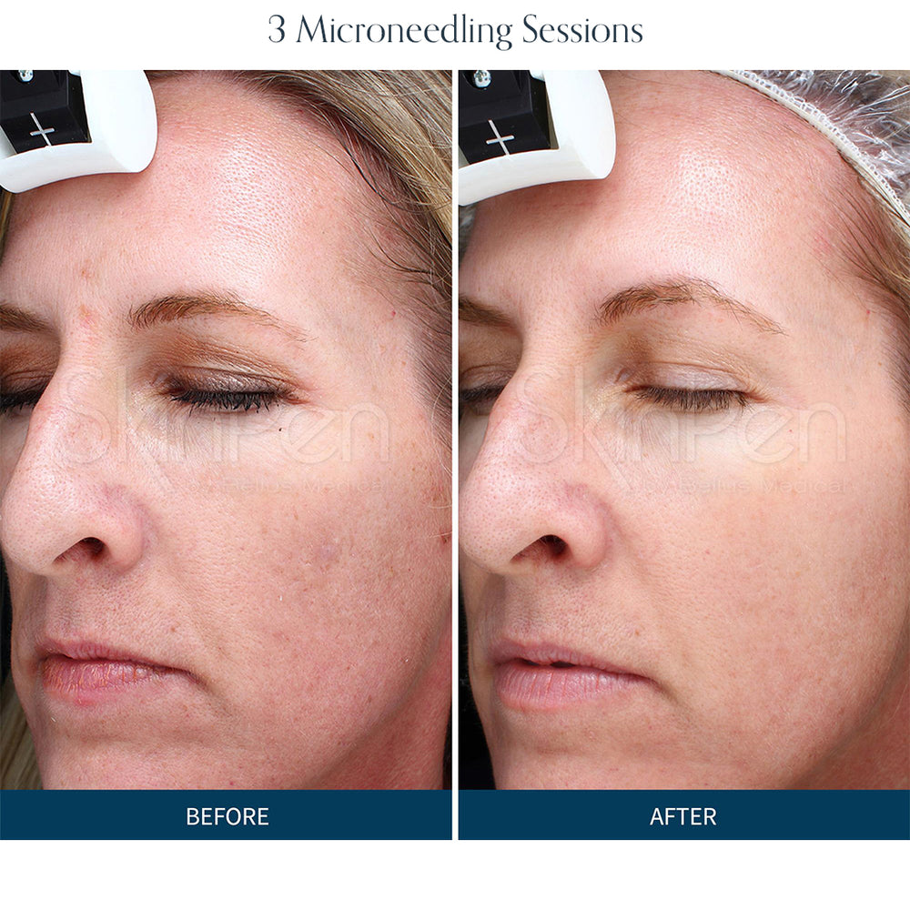 Microneedling