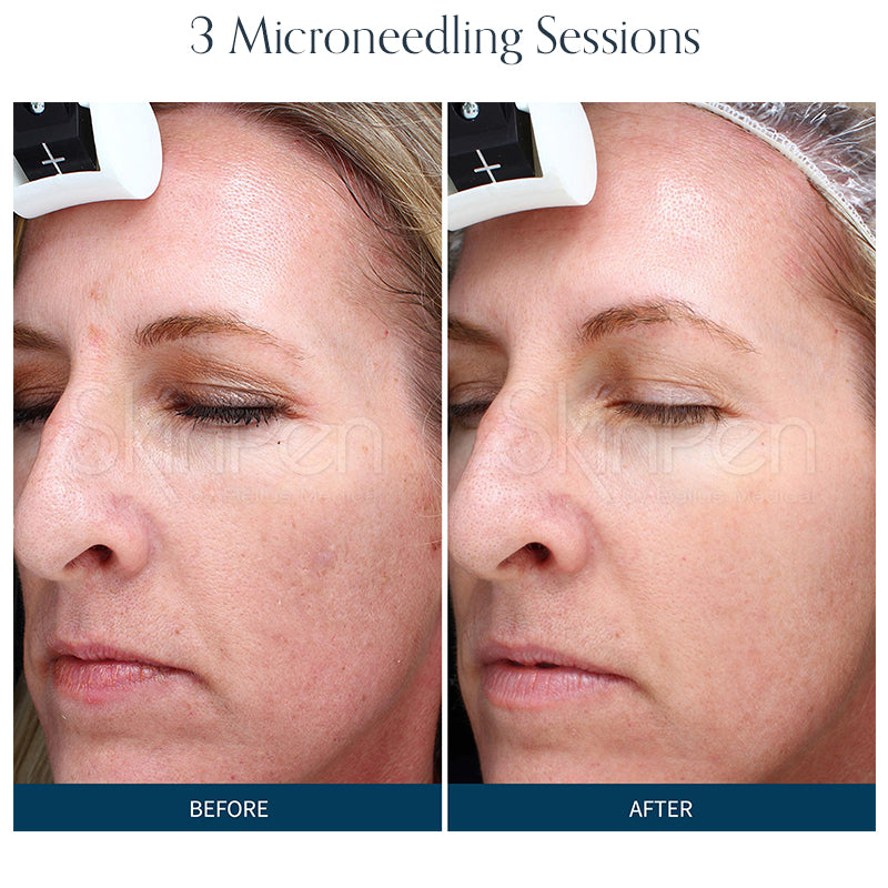 Microneedling