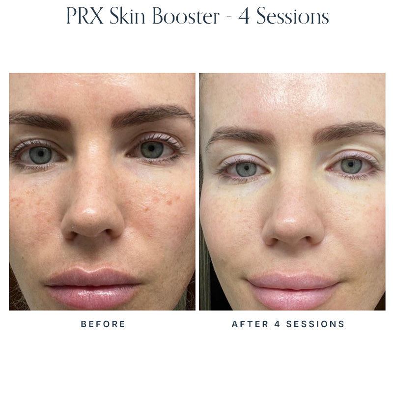 PRX Skin Boosters