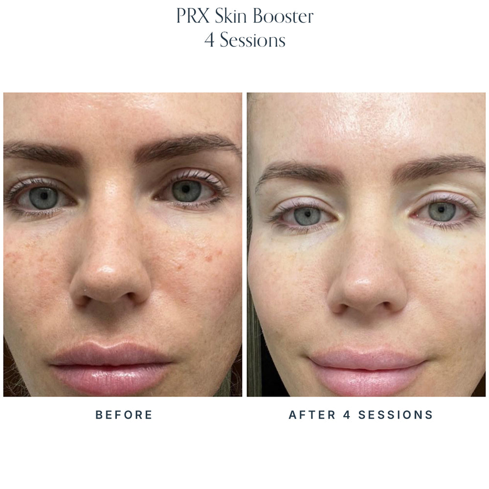 PRX Skin Boosters