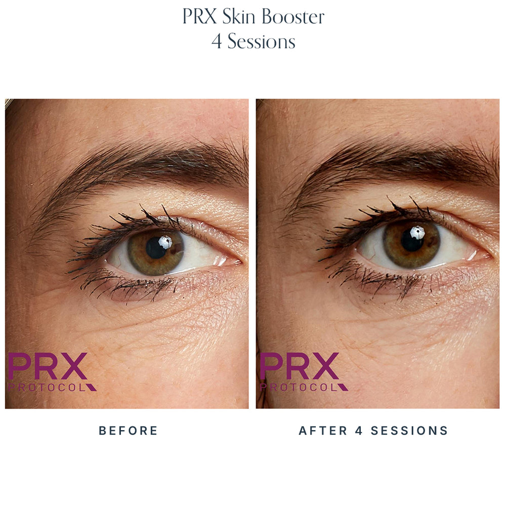 PRX Skin Boosters