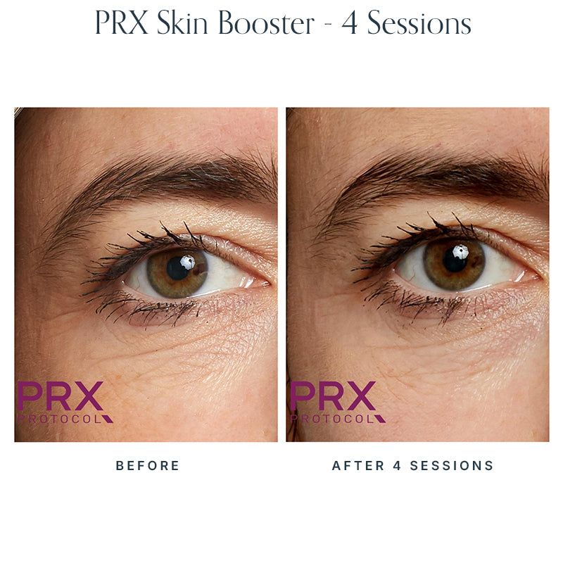 PRX Skin Boosters
