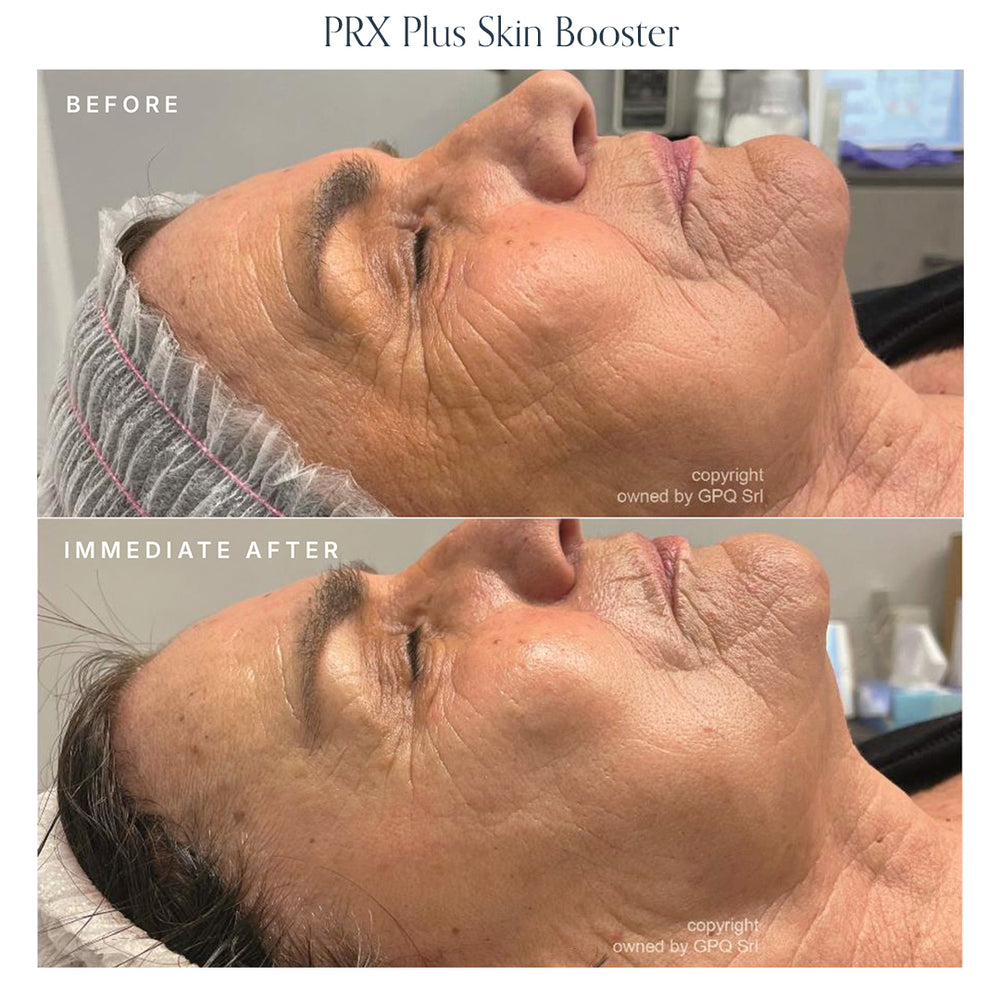 PRX Skin Boosters