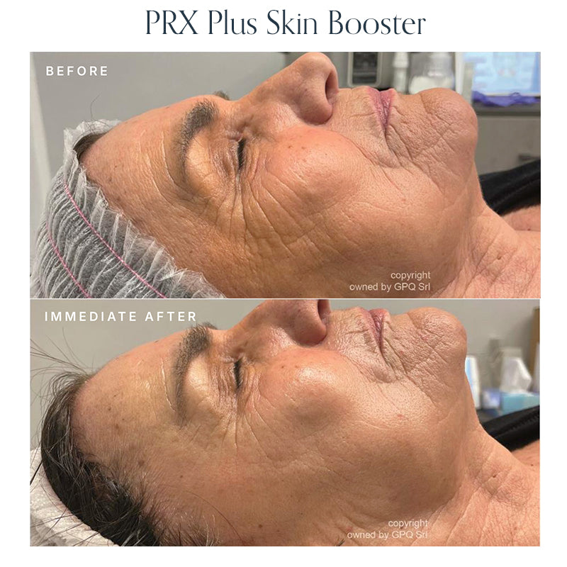 PRX Skin Boosters