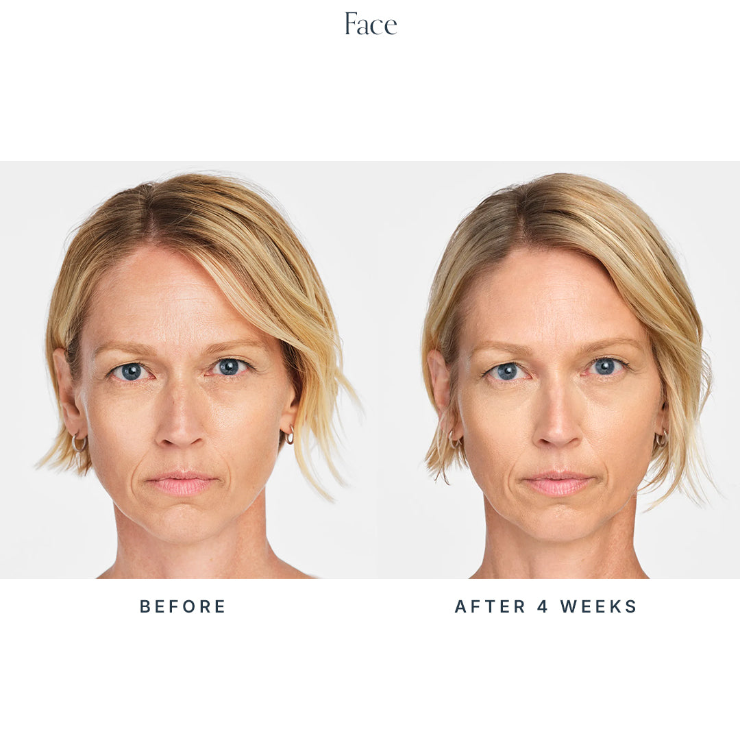 Collagen Biostimulator
