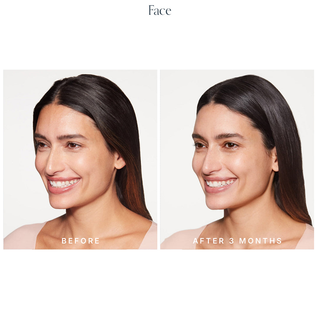 Collagen Biostimulator
