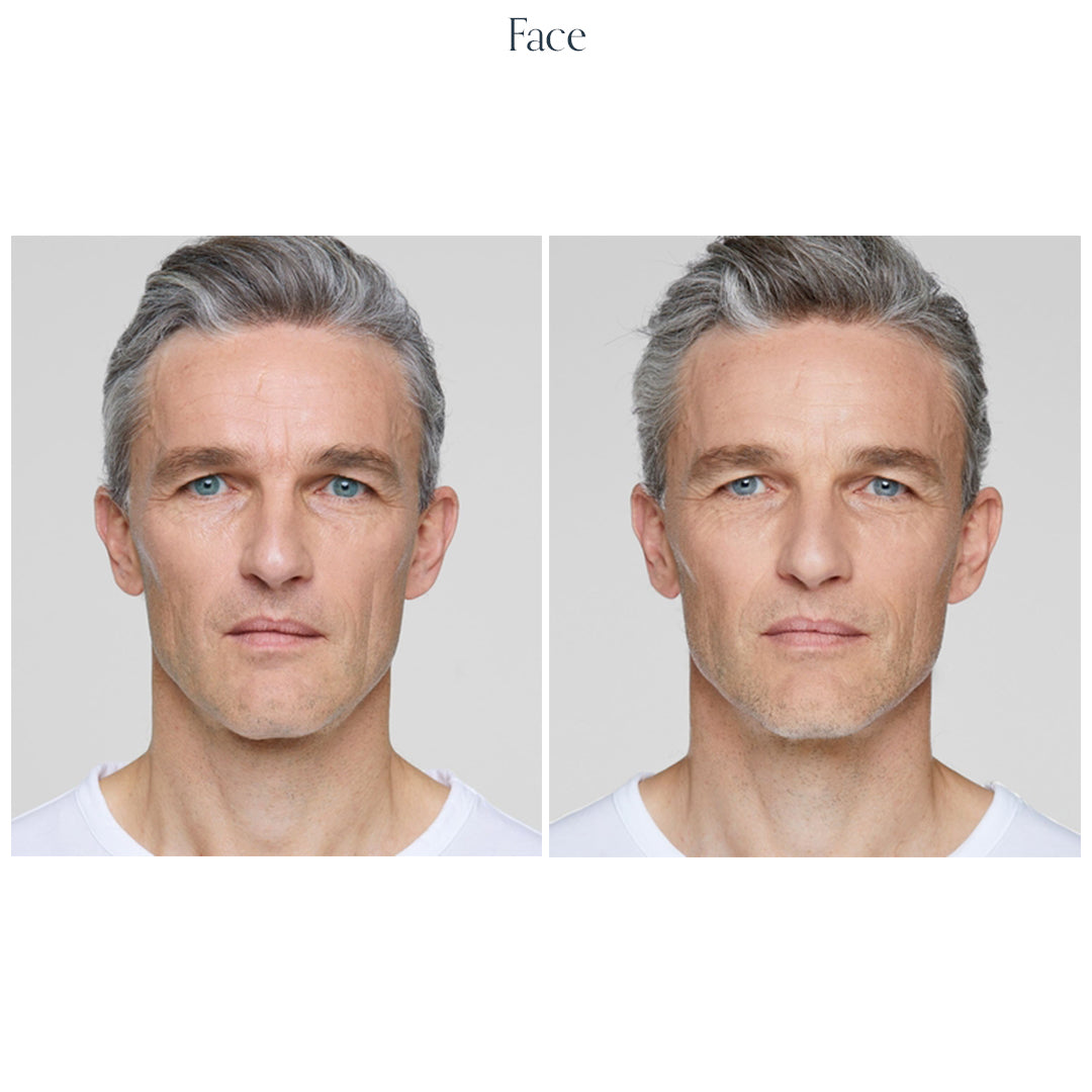 Collagen Biostimulator
