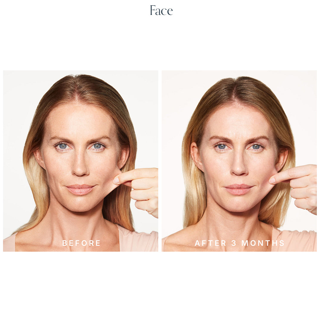 Collagen Biostimulator