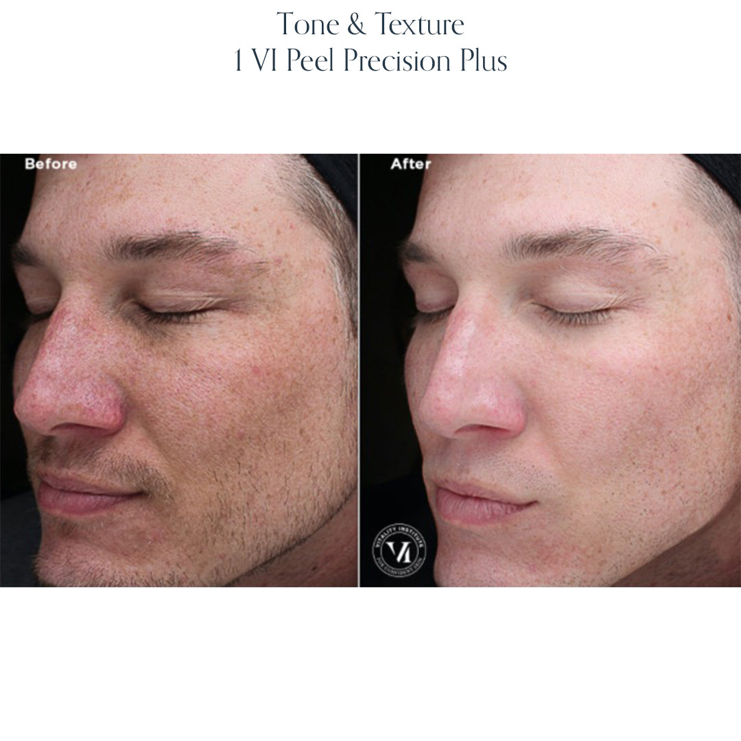 Chemical Peel
