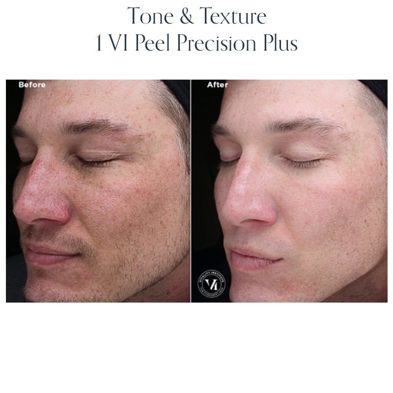 Chemical Peel