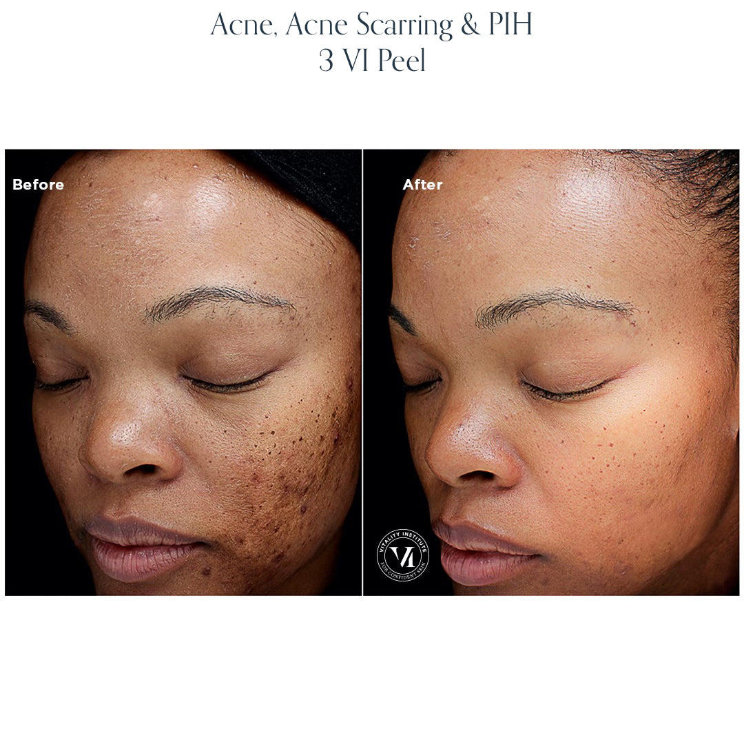 Chemical Peel
