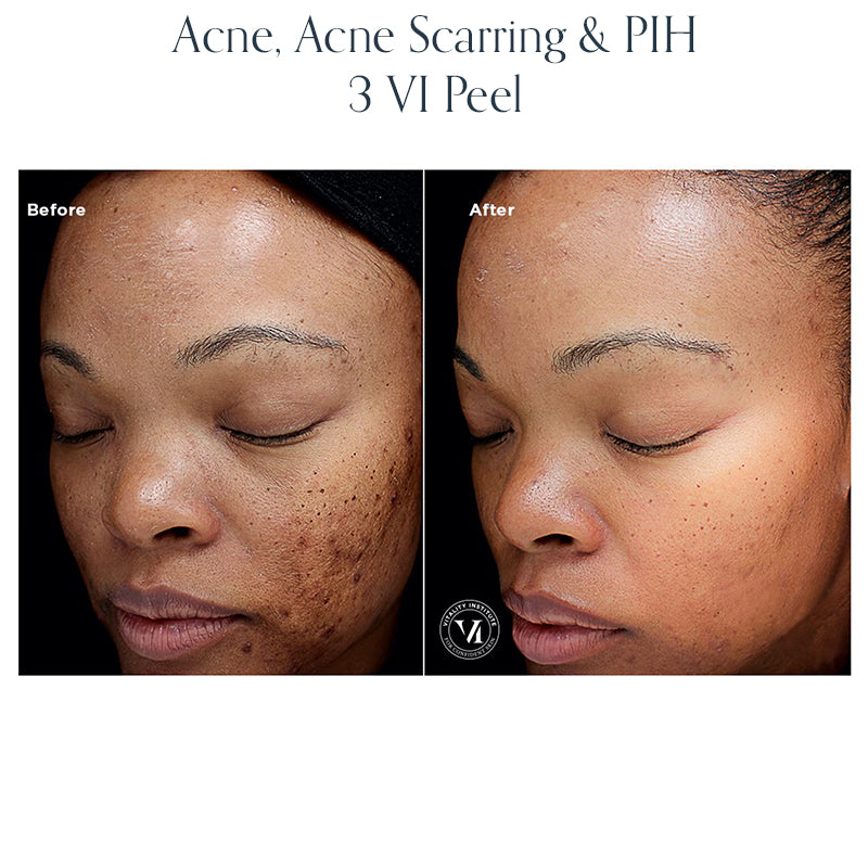 Chemical Peel
