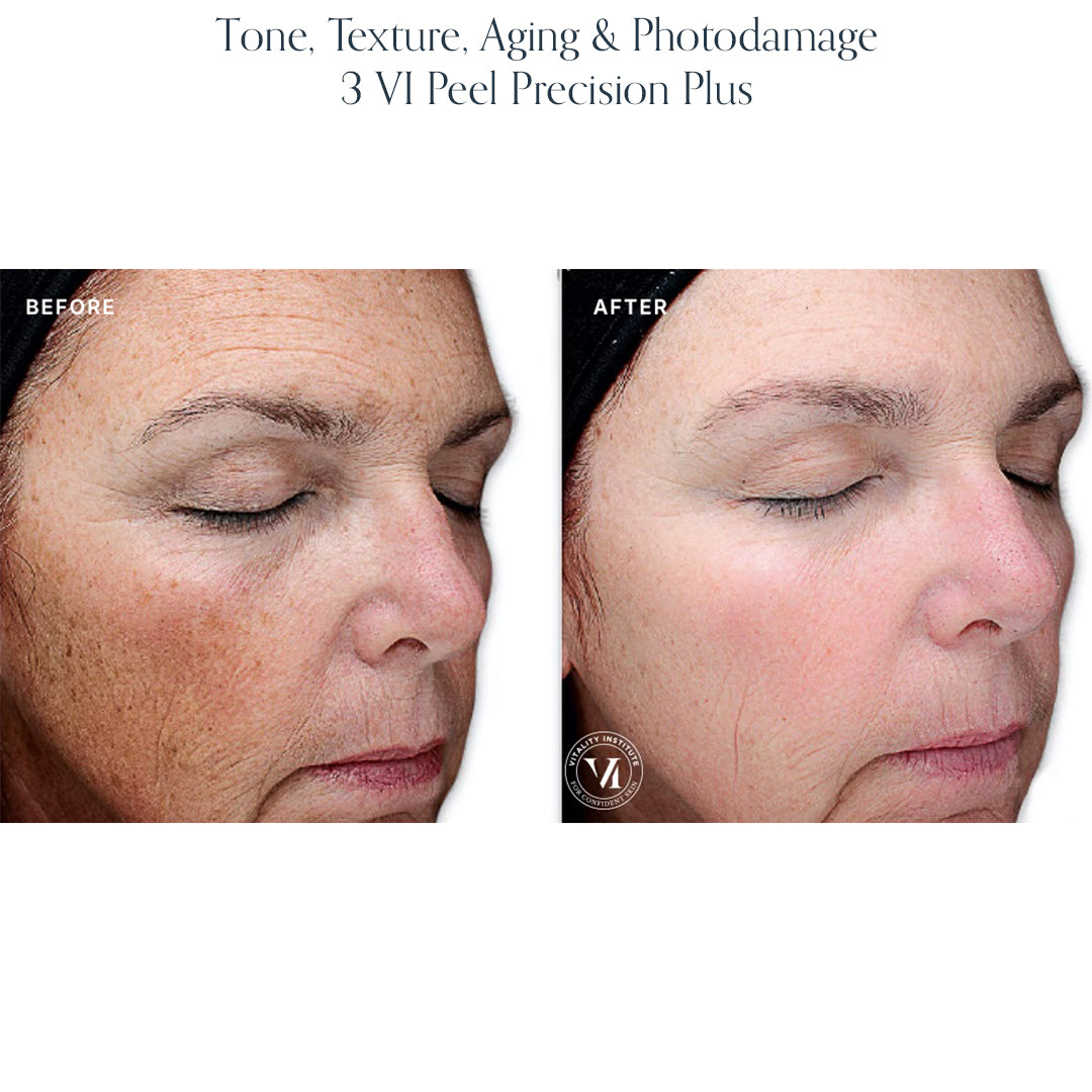 Chemical Peel