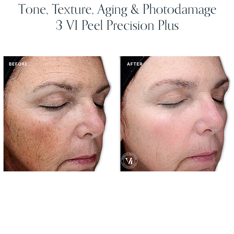 Chemical Peel